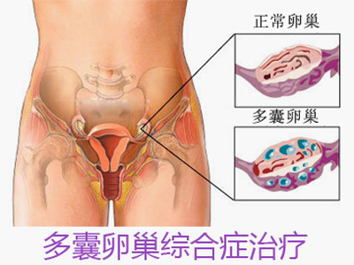 多囊卵巢综合症怎么治疗？哪种方法Ψ有效？