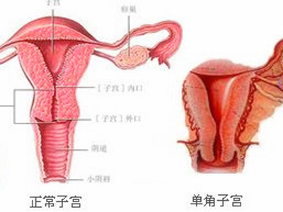 单角子宫是什么意思？影响怀孕吗？