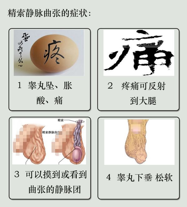 当心精索静脉曲张废掉男性生育力