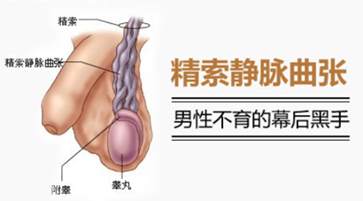 精索静脉曲张