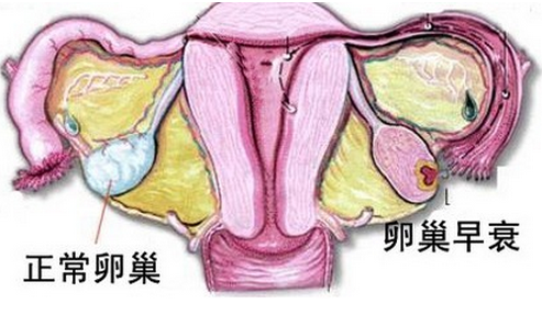 卵巢早衰的预防