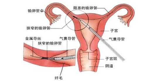 子宫内膜异位